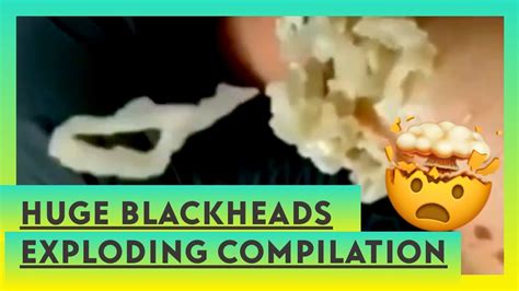 blackheads exploding